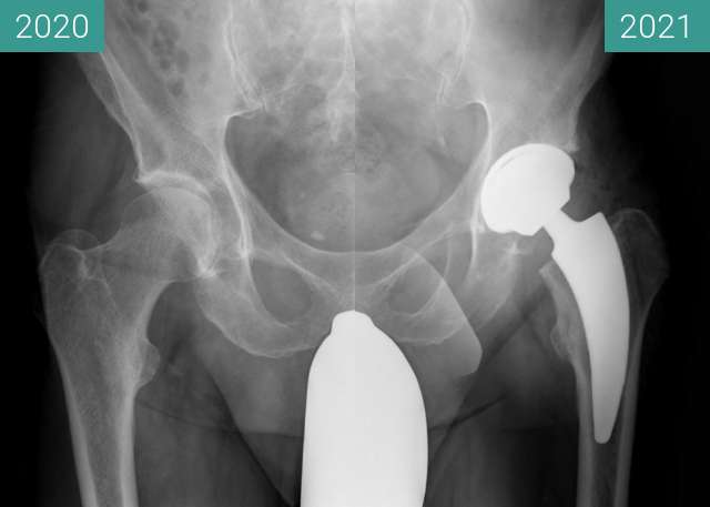 Before-and-after picture of Meine neue Hüfte between 2020-Nov-16 and 2021-Feb-05